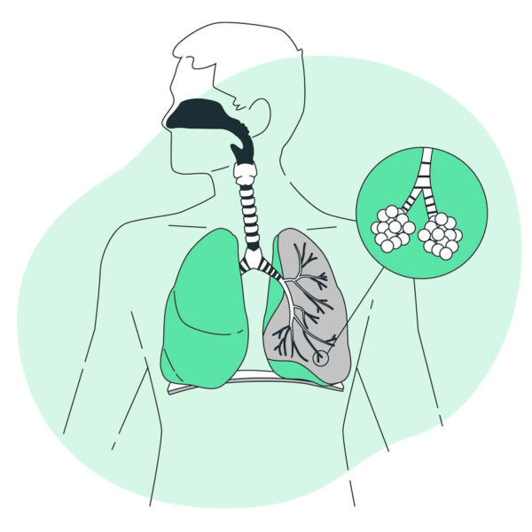 El Rol Crucial de las Aerocámaras Antiestáticas y Bivalvulares en el Tratamiento Respiratorio
